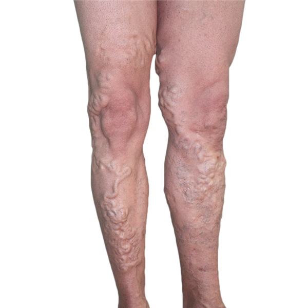 If varicose veins are not treated ...: