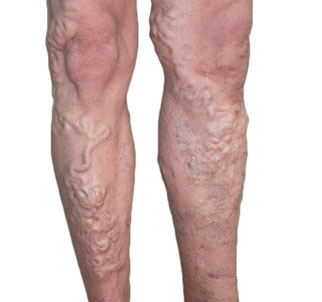 If varicose veins are not treated ...: